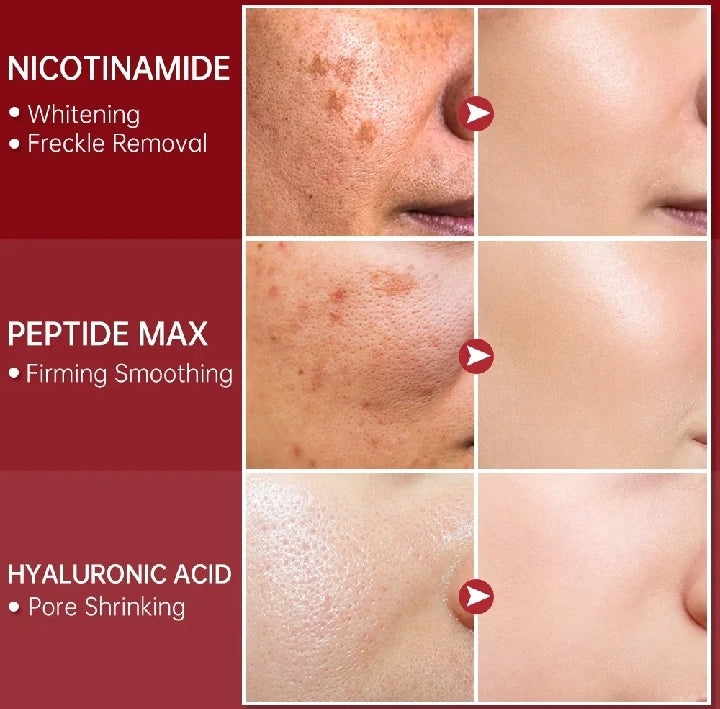 FORT Salicylic Acid Serum – Anti-Acne Face Serum & Dark Spot Correcting Serum for Glowing Skin